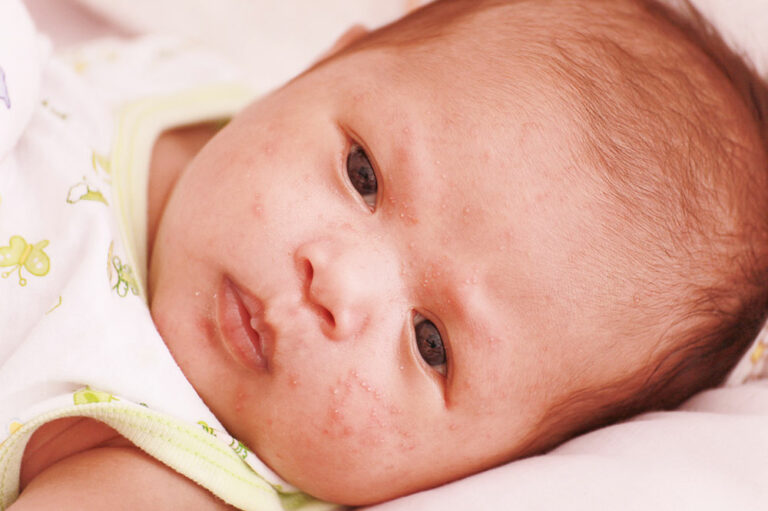 Atopic dermatitis in infants – Signs and management tips
